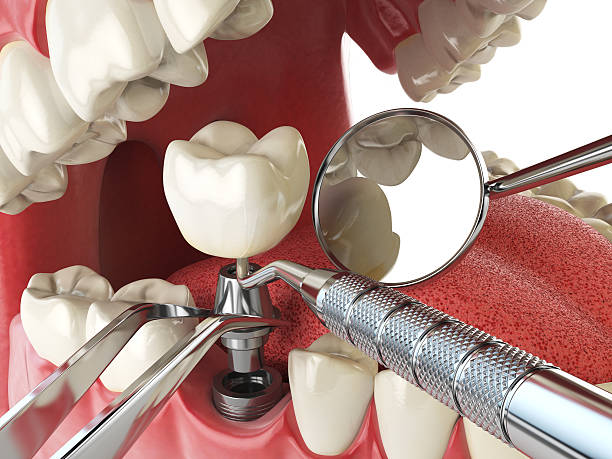 Best Emergency Dental Care for Broken or Chipped Teeth in Spring City, TN